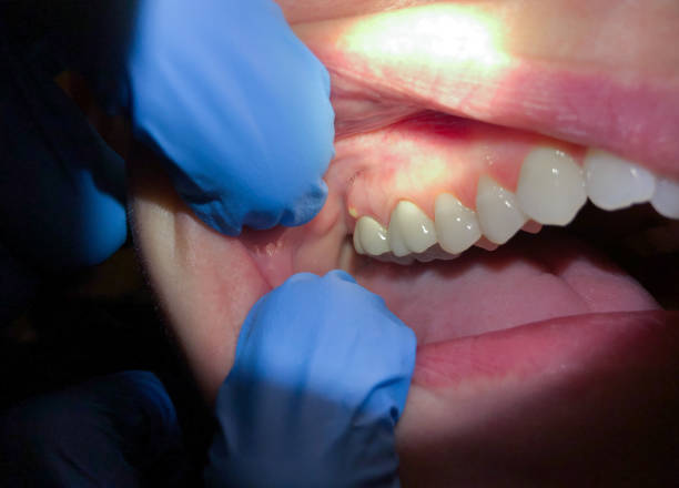 Best Emergency Wisdom Teeth Removal in Clinton, WA